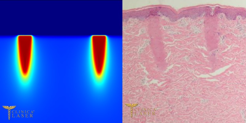 smagliature_laser_01